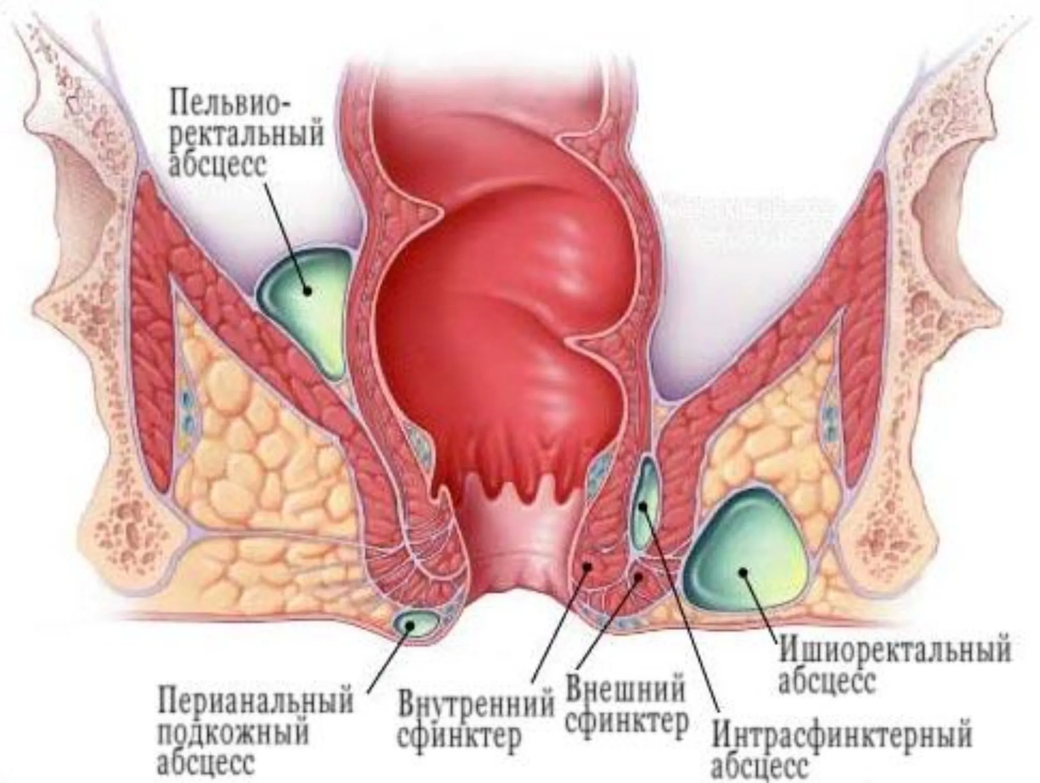 острый парапроктит
